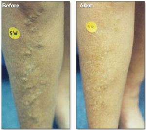 Varicose Veins Treated with Sclerotherapy