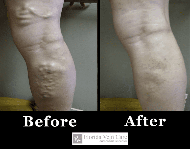 Before and After Spider Vein Treatments in Orlando